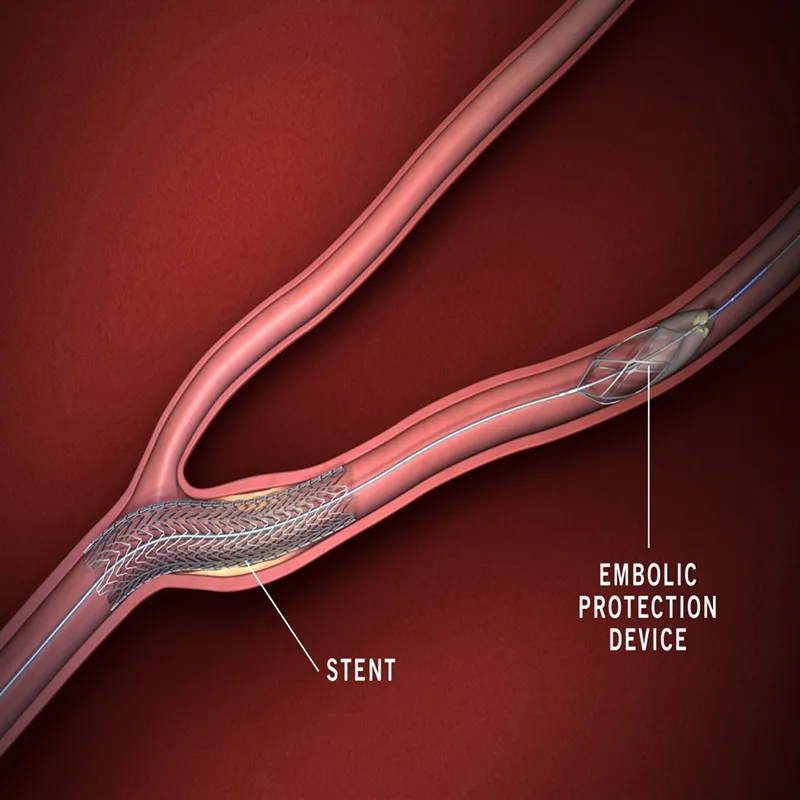 Graphic of a stent in an artery